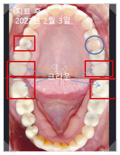 국산임플란트가격? 이 글로 종결합니다. 관련 이미지 6
