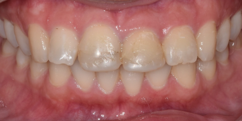 라미네이트올세라믹, 차이점과 치료사례까지 모두 공유합니다. 관련 이미지 7