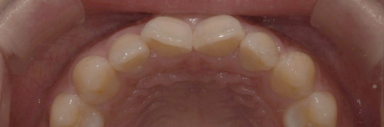 라미네이트 #내돈내산 찐후기 (feat. 직원이 받은 솔직후기2) 관련 이미지 2