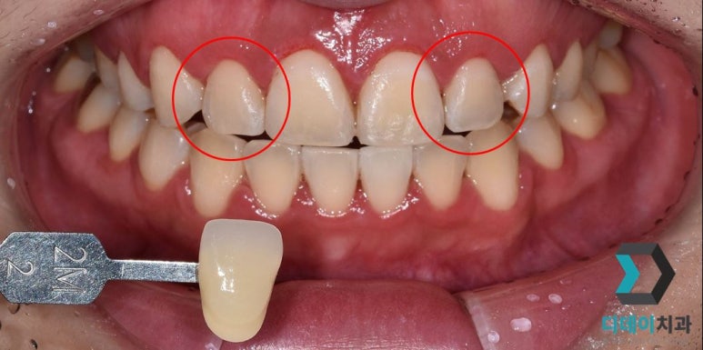 선릉역 잇몸성형, 가격보다 관련 이미지 4