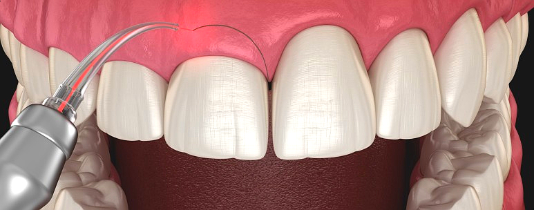 잇몸비대칭, 30분만에 개선하는 방법과 최근 치료사례 공유 관련 이미지 5