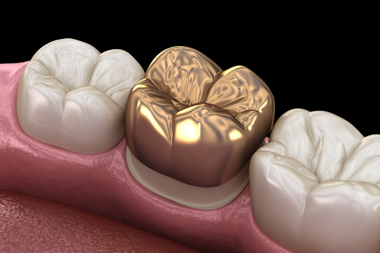 치아크라운비용, 금? 지르코니아? 전부 다 알려드립니다. 관련 이미지 6