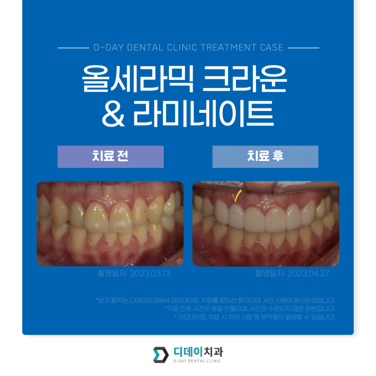 라미네이트 치아삭제? 무삭제만이 정답은 아닙니다. 관련 이미지 3