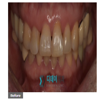 재교정 vs 라미네이트 고민되신다면, 이 글로 종결! 관련 이미지 2