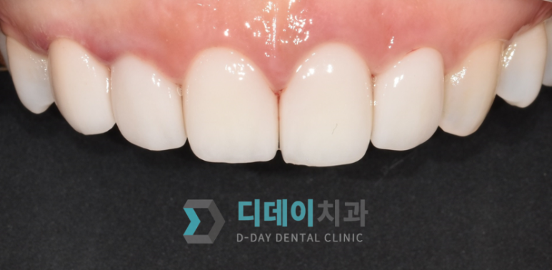 라미네이트 재시술,의사가 직접 설명합니다 관련 이미지 8