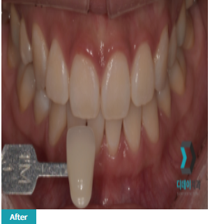 치아미백 vs 라미네이트, 누렁니 탈출하고 싶으신 분들만 관련 이미지 5