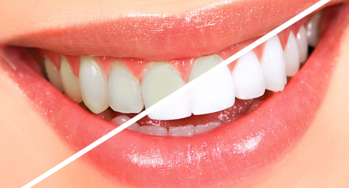 치아미백 지속기간,가격, 부작용, 횟수, 총정리 해드립니다. 관련 이미지 4