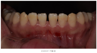 라미네이트유지기간, 절반도 못 쓰고 후회하는 환자들의 공통점 관련 이미지 7