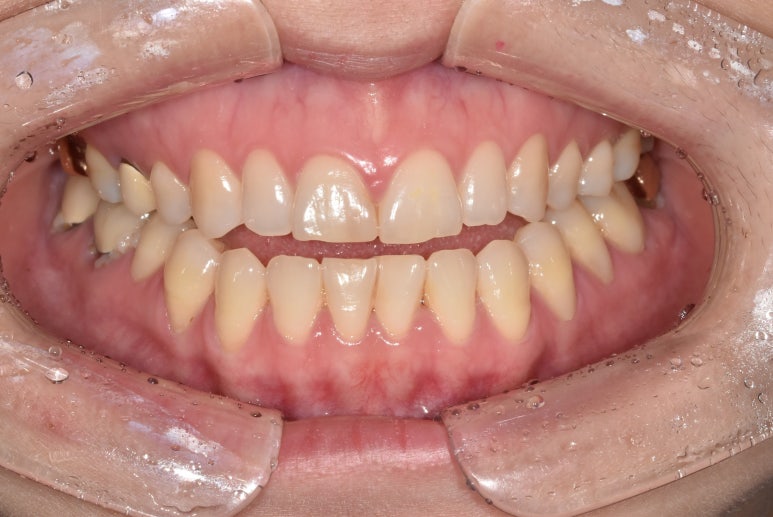 라미네이트통증, 아플까봐 걱정된다면? 확인해보세요 관련 이미지 5