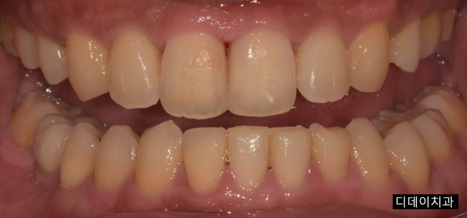 치아레진수명,10년 이상 쓰려면 이것만은 알아야 합니다 관련 이미지 7