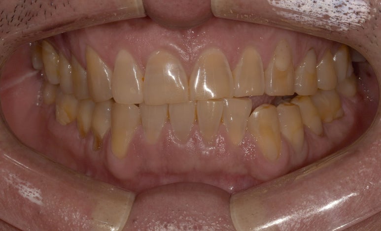 치아도 녹아내린다? 치아부식 원인과 치료방법은? 관련 이미지 4