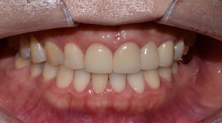 앞니브릿지, 치료기간 앞니 없이 생활해야하나요? 관련 이미지 4