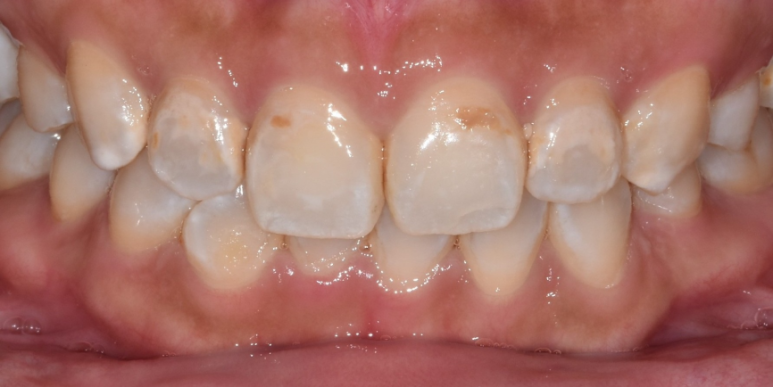 라미네이트 전후 비교, 주의사항, 비용까지 총정리 관련 이미지 9