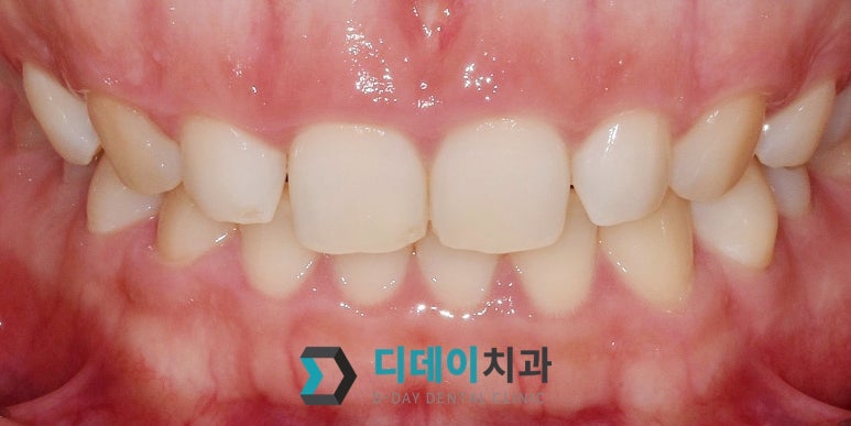 웃을 때 잇몸이 많이 보인다면, 몰라서 못하는 이것 관련 이미지 11