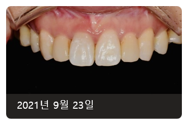 라미네이트치아삭제? "2년간 고민"하셨던 환자분 사례 관련 이미지 1