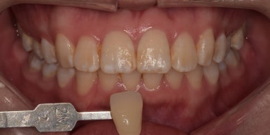 [진심인터뷰] &ldquo;한국까지 와서 원데이치아미백 했어요&rdquo; - 일본에서 온 두 친구 이야기 관련 이미지 4