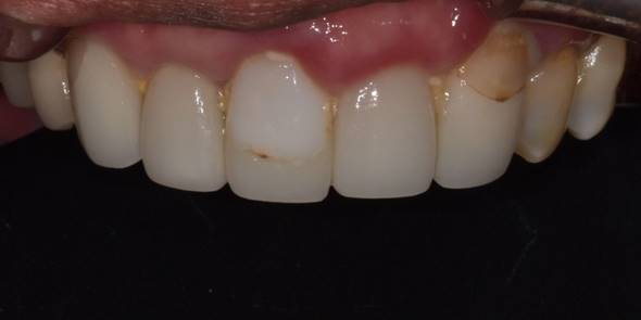 라미네이트교체, 재시술은 더 신중해야 하는 이유? 관련 이미지 5