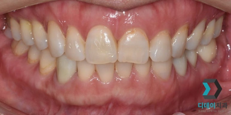 크라운수명, 10년 넘게 쓰고도 교체 안 할 수 있다? 관련 이미지 4