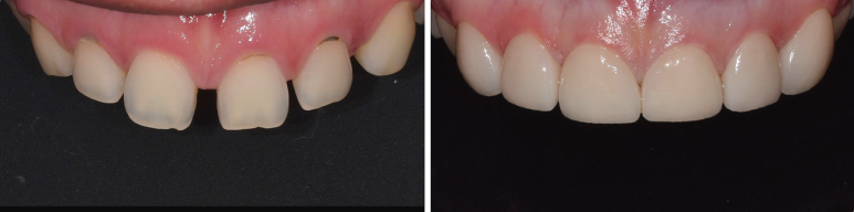 최소삭제라미네이트, 비용부터 치과 고르는 방법 관련 이미지 9