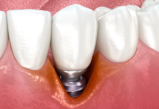 한티역 임플란트, 환자 10명 중 7명이 놓치는 포인트 관련 이미지 3