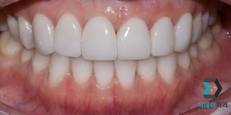 라미네이트교체, 재시술은 더 신중해야 하는 이유? 관련 이미지 2