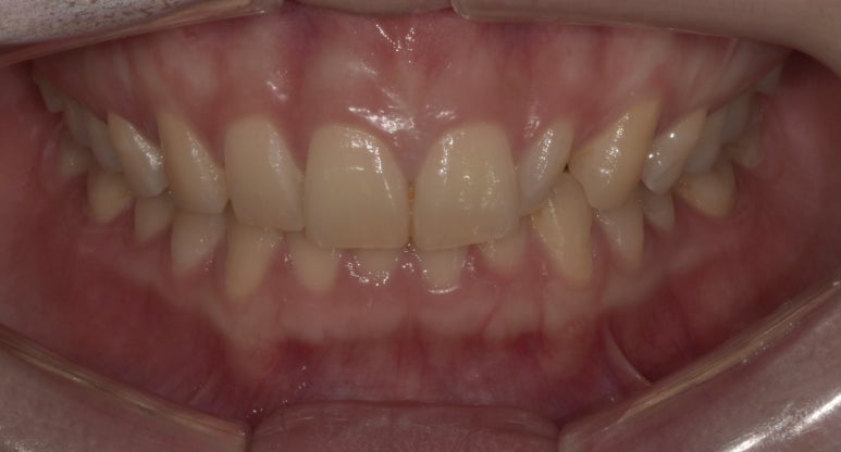 왜소치(작은치아), 꼭 치료해야할까요? 정답 알려드립니다. 관련 이미지 2