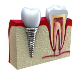 한티역치과 임플란트, 기저질환있어도 가능한지 의사가 답합니다 관련 이미지 2