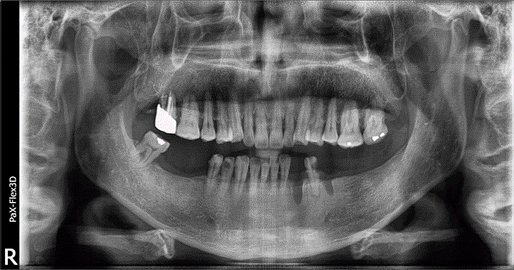 상악동 거상술 비용, 통증까지 치과의사가 알려드립니다 관련 이미지 1