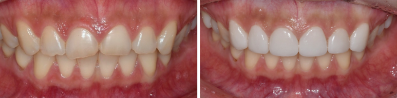 라미네이트색상, 모양 후회 안하려면? 관련 이미지 9