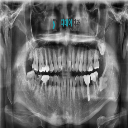 강남역 치과 임플란트 수면마취?해야만 하는 경우 관련 이미지 2