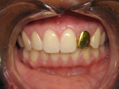 골드크라운비용? 장단점과 수명까지 한번에 정리해드립니다. 관련 이미지 6