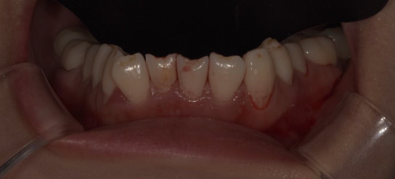 교정없이 라미네이트로 치아배열 개선? 앞니 12개 케이스 공개 관련 이미지 3