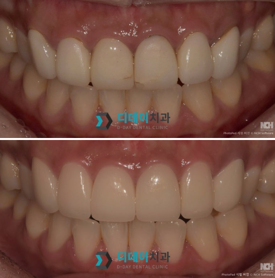 선정릉치과 라미네이트 vs 크라운, 어떤 치료가 맞을까요? 관련 이미지 8