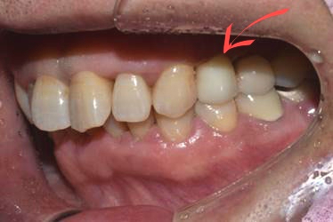 국산임플란트를 선택한 이유, 치료사례 공개합니다 관련 이미지 13