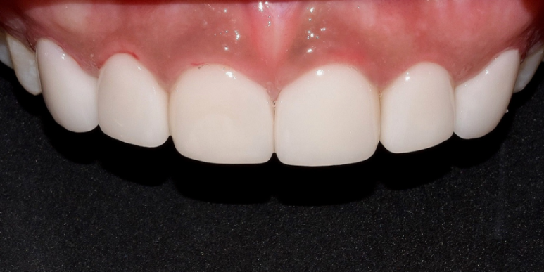 라미네이트 전후 비교, 주의사항, 비용까지 총정리 관련 이미지 2