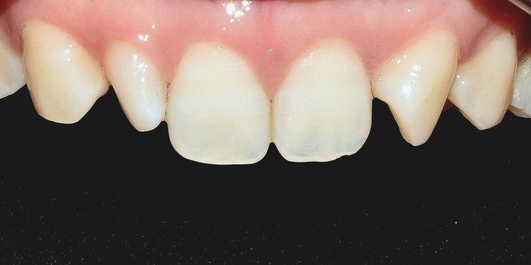 작은치아라미네이트, 전후 비교와 비용 설명까지 관련 이미지 3