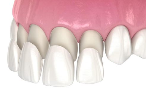 치아 화이트닝, 이번에는 황니 탈출 가능할까? 관련 이미지 4