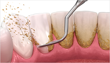 스케일링때문에 치아가 깨졌다구요? 스케일링에 대한 오해와 진실 관련 이미지 3