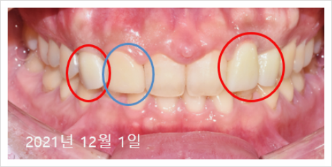 디지털임플란트 가격? 관련 이미지 4