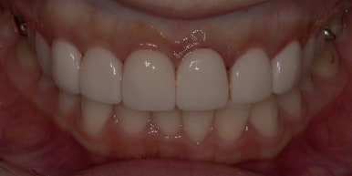 [진심인터뷰] 라미네이트후기, 일본인환자가 디데이치과까지 온 이유? 관련 이미지 3