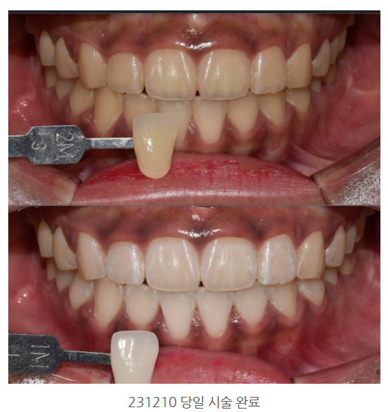 치과 치아미백, 돈 날리고 싶지 않다면? 관련 이미지 2