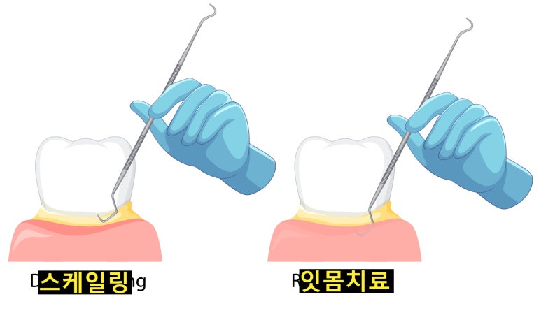 치아결손 시 암 위험 증가? 구강내 염증의 엄청난 나비효과 관련 이미지 5