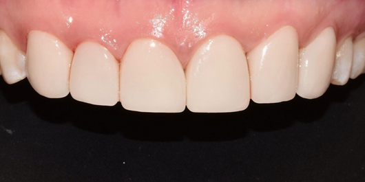 작은이빨, 왜소치? 치아 크기를 키우고 싶은 분만 <필독> 관련 이미지 4