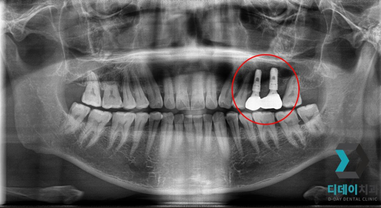 기저질환 환자, 임플란트 가능할까요? 관련 이미지 5