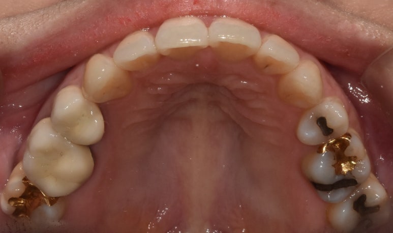 골드인레이, 장단점과 비용 및 크랙 가능성까지 모두 밝힙니다. 관련 이미지 4