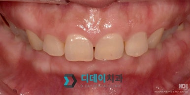 Protruding Mouth Laminate: Read This If Your Side Profile Has Been Especially on Your Mind image 4
