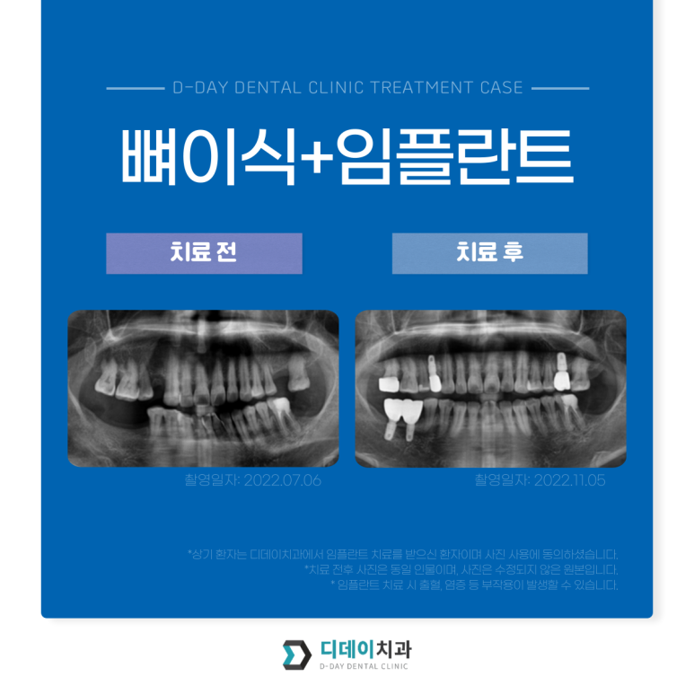 임플란트치료기간 케이스별로 자세히 설명드립니다. 관련 이미지 3