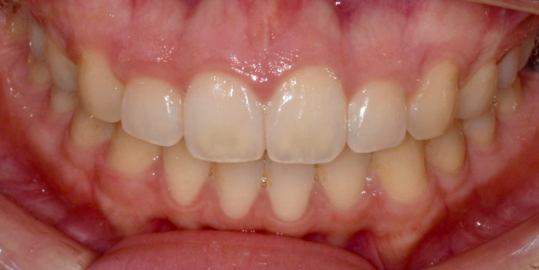 잇몸성형가격? 비용, 주의사항, 치료 후기 공개 관련 이미지 11