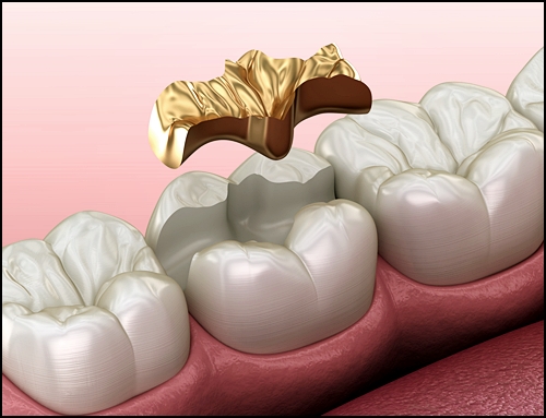 레진 인레이 차이, 치과의사가 알려준다면? 관련 이미지 3