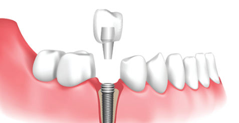 언주역치과, 임플란트 실력 있는 곳은 이 2가지에서 확 차이납니다 관련 이미지 4
